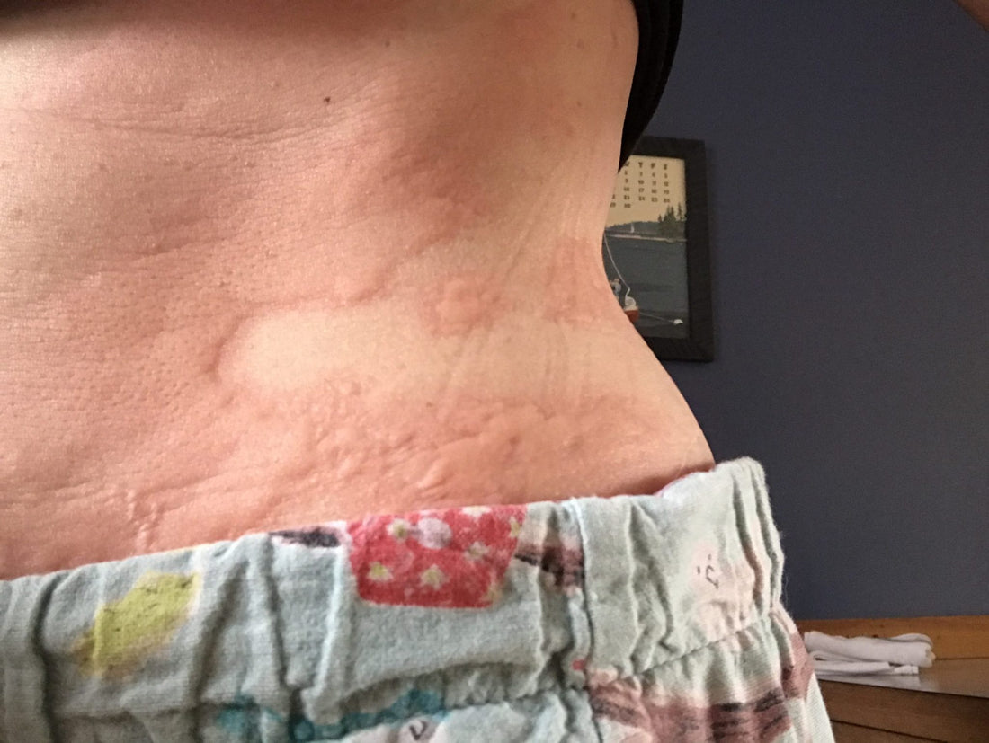 Stay Healthy! 


When your skin looks like a topographic map… you know it’s summer in New England. 

Yep. Lucy apparently got into some poison ivy, oak or sumac and then snuggled up next to me. GOOD TIMES! 

Weigh What I Weighed When We Got Married ...